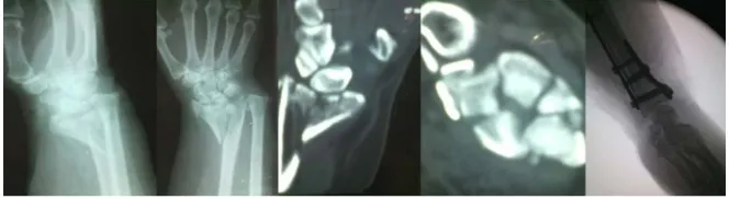 Figure 2. Intra-articular comminuted fracture distal radius treated by sandwich double plating