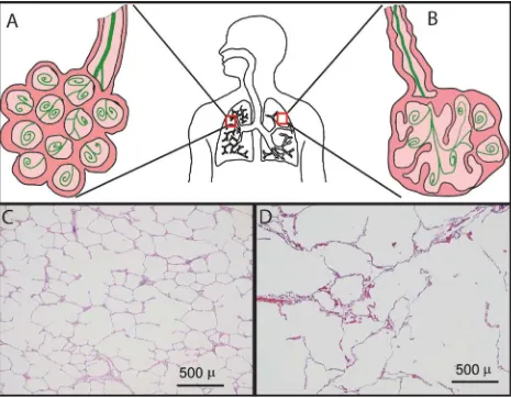Figure 1.3: Healthy and emphysematous alveoli Schematic of normal and emphysematous alveoli are shown in A and B
