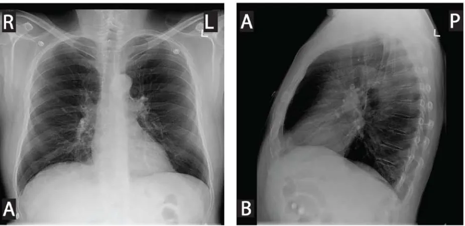 Figure 1.5: Chest x-ray of a COPD subject X-ray radiograph chest images of 62 year-old male with severe COPD
