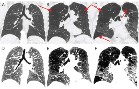 Figure 1.6: X-ray CT of healthy and emphysematous lungs Lower row displays the same images as upper row in a different window and level