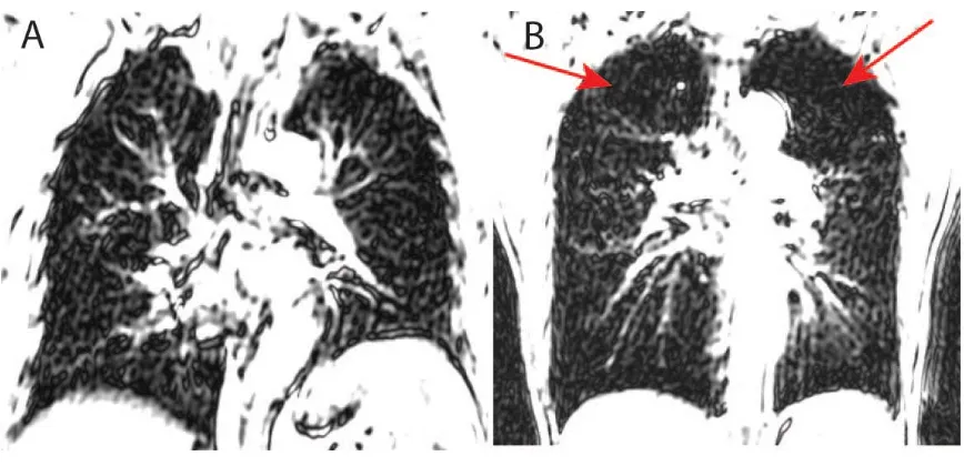 Figure 1.8: Conventional 1Although, lung 1H MRI images are affected by low proton density and high susceptibility artifacts, short TE MRI can provide regional information regarding the emphysematous H MRI of healthy and emphysematous lungs Conventional pul