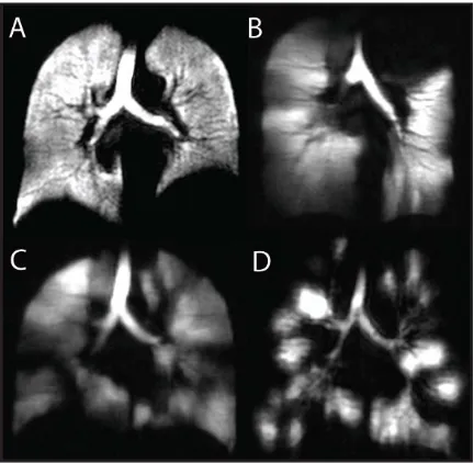 Figure 1.9: Hyperpolarized 3He MRI of a healthy volunteer and subjects with different lung diseases 