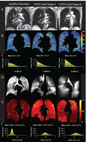 Figure 2.1: 1H and 3He MRI for a healthy never-smoker and GOLD stage II and III COPD. 