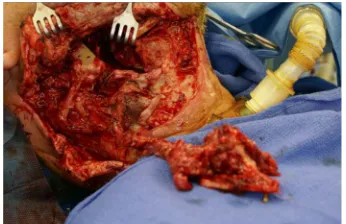 Figure 4. A 30-year-old male with a partial mandibulec- tomy defect was successfully reconstructed with an osteo- cutaneous radial forearm free flap