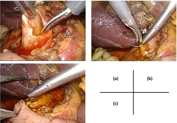 Figure 1. Laparoscopic operative findings. (a) Longitudinal choledochotomy about 2.0 cm at the center of the common bile duct (CBD)