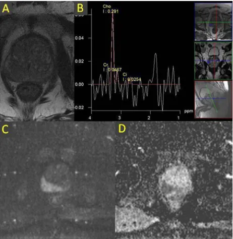 Figure 3. T2W image (A) shows irregular hypoinensity on the right side (in peripheral, transitional and central zones) and H-MRS (B) depicts high Cho/Cit ratio in right periph-eral zone