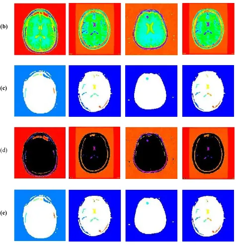 Figure 3. shows segmented medical image (a) original image (b) colored MRI brain image (c) image showing boundaries (d) Segmented MR brain image using MST (e) Image showing tumor area