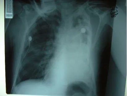 Figure 1: Unfixed flail chest on left side with collapsed lung 