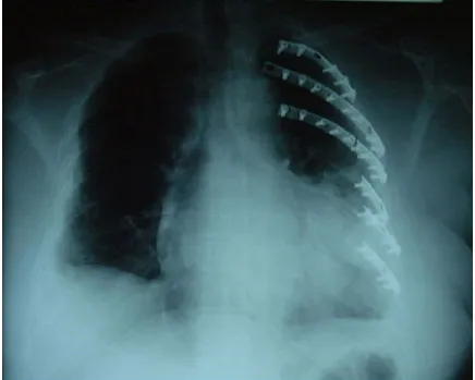 Figure 2: Operative repair of flail chest using plates and screws 