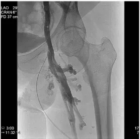 Figure 1. Stage 4a or 4b characteristics: Left common iliac vein compression with cross-pelvic collateralization, with collaterals causing early filling of the right common iliac vein and inferior vena cava