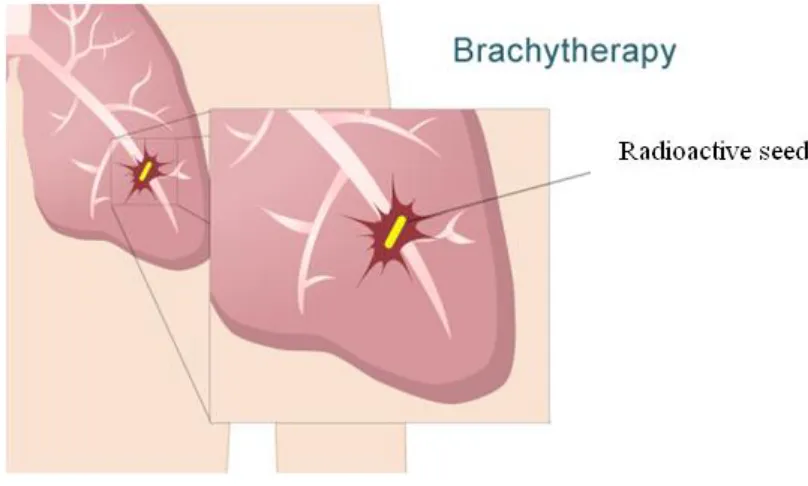 Figure 1.4: Brachytherapy 
