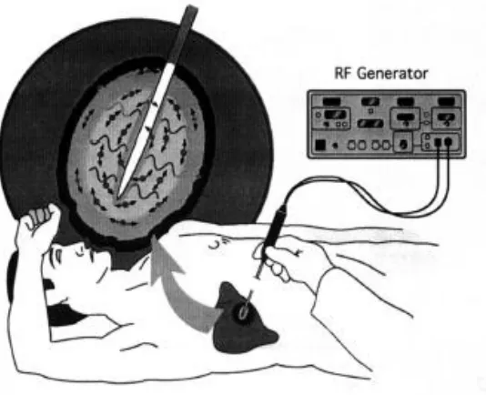 Figure 1.7: Radiofrequency ablation 