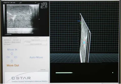 Figure 1.11: InterNAV setup for lung brachytherapy 