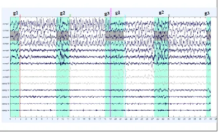 Figure 6: EEG Output from Single EEG Channel after Filtering and ICA (where ‘g1’ represents gait initiation, ‘b1’ first section of baseline continuous gait, ‘g2’ represents the turning events, ‘b2’ is the second section of baseline continuous gait, and ‘g3