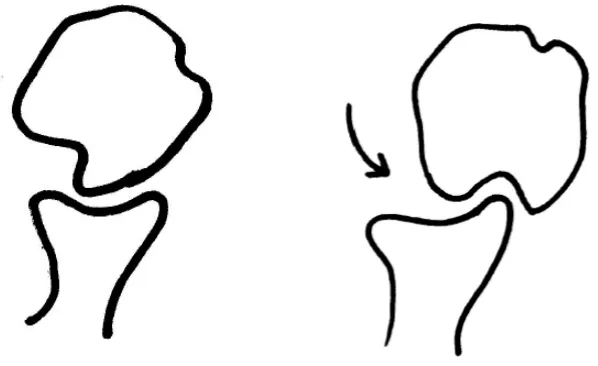 Figure 1-9.  Hill-Sachs Defect Engagement in External Rotation  