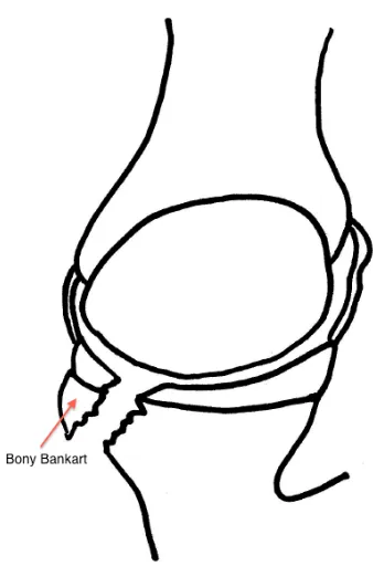 Figure 1-10. Bony Bankart Lesion  