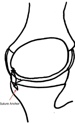 Figure 1-11. Bankart Stabilization  