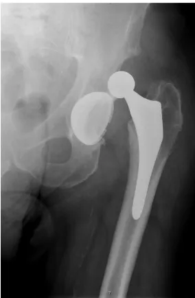 Figure 2. Both acetabular components were well-fixed. An excessive inclination angles of the acetabular components can be observed, 56 degrees in the right hip and 60 degrees in the left
