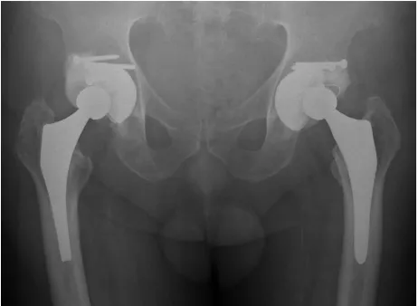 Figure 5. Postoperative radiograph showing the bilateral acetabular reconstruction. An acetabular augmentation 