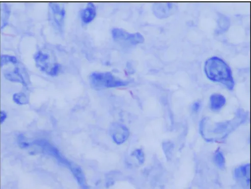 Figure 1. Polyomavirus kidney—biopsy (HE 400×). 