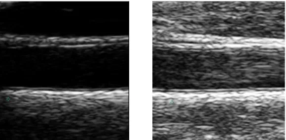 Figure 5: Two different ultrasound longitudinal images of the CCA with different intensities.