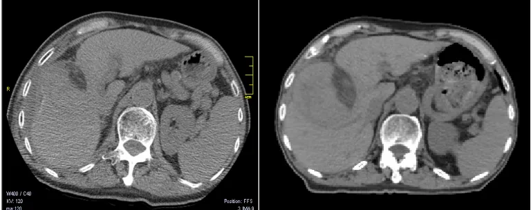 Figure 3: DCE-CT and 4D-CT slices of same patient. 