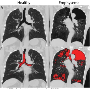 Figure 1-13 Coronal CT of a healthy smoker and a COPD ex-smoker The central slice coronal CT image (A) with the corresponding density mask with all voxels with attenuation values less than -950 HU highlighted in red (B) for a healthy subject and a COPD sub