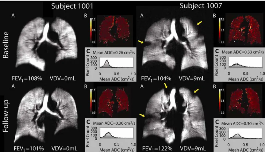 Figure 2-1 Representative hyperpolarized 3He MR at baseline and follow-up in healthy never-smokers Left panel subject 1001 58 year old male: top panel is baseline and bottom panel is follow-up:  (A) ventilation image (B), ADC map (C) and ADC histogram