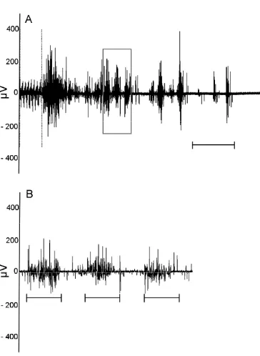 Figure 2 Example of characteristic BCM EMG induced by DPN stimulation.Example of characteristic BCM EMG induced by DPN stimulation