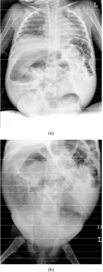 Figure 2. Images taken during contrast enema performed on the same patient. The transition zone is clearly seen