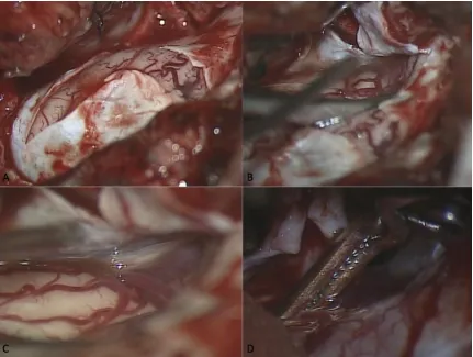 Figure 2 Intradural Exposure  A.  Microscope view, cruciate dural incision.  B and 