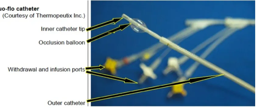 Figure 3 Thermopeutix catheter.  Distal end of the inner and outer Duo-Flo 