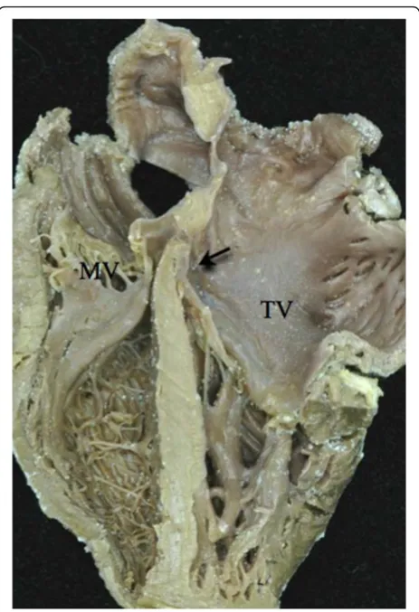 Figure 6 Note the reversed off-setting of the attachments ofthe leaflets of the atrioventricular valves to the septum(Arrow), with the mitral valve (MV) on the right side attachedappreciably higher that the tricuspid valve (TV) on the leftside.