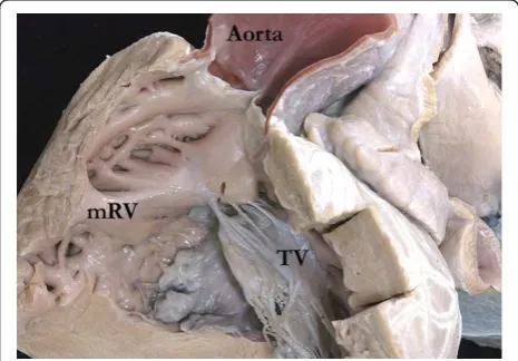 Figure 7 The image shows the fibrous continuity between theleaflets of the pulmonary trunk (PT) and mitral valves (MV) inthe roof of the right-sided morphologically left ventricle (mLV).