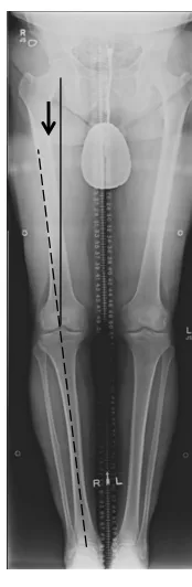 Figure 1.1: The mechanical axis angle (MAA) of the lower limb is measured as the included angle between the line connecting the knee and hip joint centers and the line connecting the ankle and knee joint centers