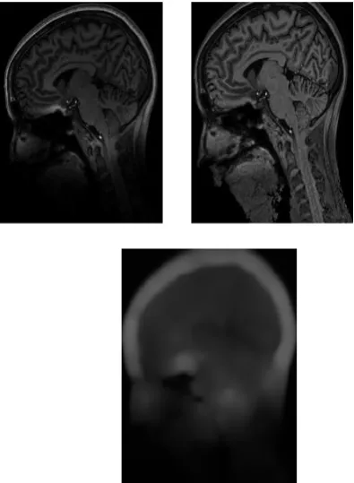 Fig. 1. Applications of our method to an X-ray image. (a) Original image and initial contour (dashed black line); (d) Bias corrected image