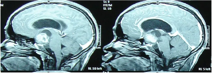Fig. 3MRI brain axial and saggital views (case 2). Note the heterogeneous appearance of the suprasellar 