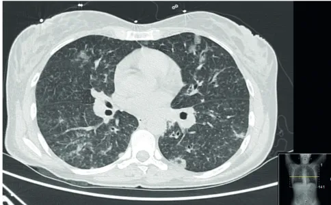 Figure 4 – Chest CT showing scattered and multifocal ground glass opacities and densities, septal thickening and micronodulation (day 1)