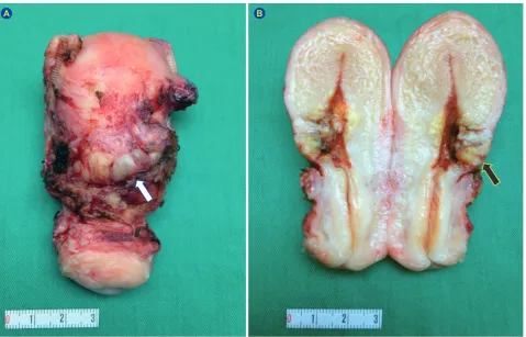 Figure 3 – Macroscopy: (A) Tumor mass with a multilobulated placental like gross appearance (white arrow); (B) dissecting growth pattern towards the serosa (black arrow)