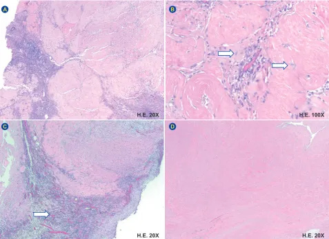 Figure 4 – Microscopy: Multilobular proliferation of a sparsely cellular hyalinized tissue (A), with foci of granulation tissue (C – arrow) and coagulative necrosis (D); with absence of mitotic figures and atypia (B - arrows)
