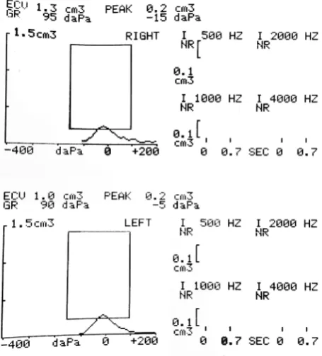 Figure 1 – Example of impedance audiometry: type As tympano-gram, with absent ipsilateral stapedial reflexes