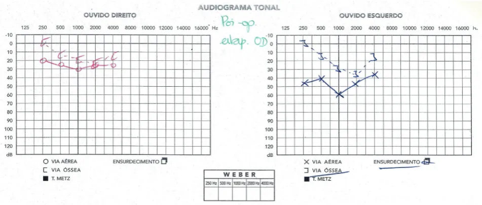 Figure 3 – Example of a postoperative audiogram: Carhart effect disappeared upon closure of air-bone gap on the right ear