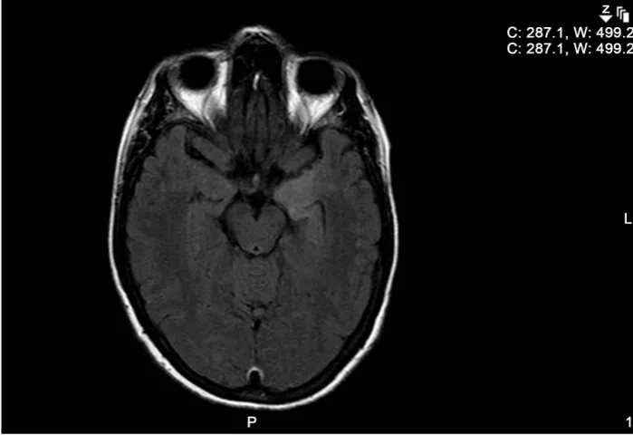 Figure 1. Axial fluid attenuation inversion recovery (FLAIR) MRI of the brain showing a bright signal temporal amygdala and left hippocampal head, turning up the cortex of the adjacent tem-poral pole, consistent with limbic encephalitis (arrow)
