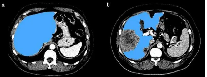 Fig. 5: Challenges of MR image segmentation: the healthy liver parenchyma has different intensity at different locations due to signal  inhomogeneity (a – arrow in left lobe) or near the boundary of the acquired field of view (c – arrow in the top of the l