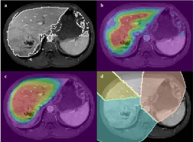Fig. 6. The input image is thresholded (a), distance map is computed (b – red colour represents large distance), registered probability map (c –  red colour represents high probability), dilated average liver shape with anatomical segment information using