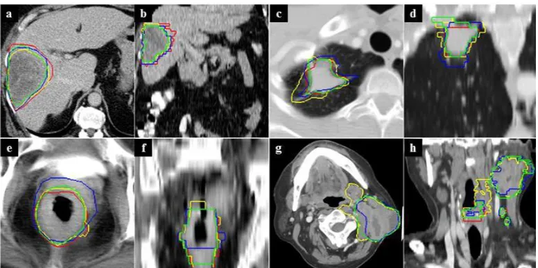 Fig. 7: Inter-operator variability of tumour contouring for liver (exam 3 – a, b), lung (exam 8 – c, d), rectum (exam 11 – e, f ), and neck (exam  9 – g, h) tumours: The axial (a, c, e, g) and coronal (b, d, f, h) views are displayed