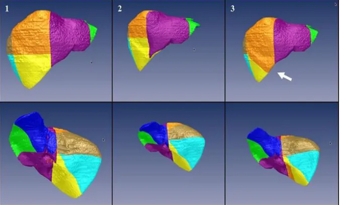 Fig. 10: Result of the liver segmentation for exam 14 in 3 different times (in columns): each result is shown from anterior (top) and posterior  (bottom) views