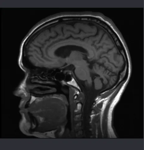 Figure 4 – Macular dystrophy present in index case