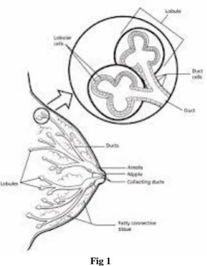 Fig 1  The first symptom of breast cancer that can be noticed is a lump that feels different from the rest of breast tissue 