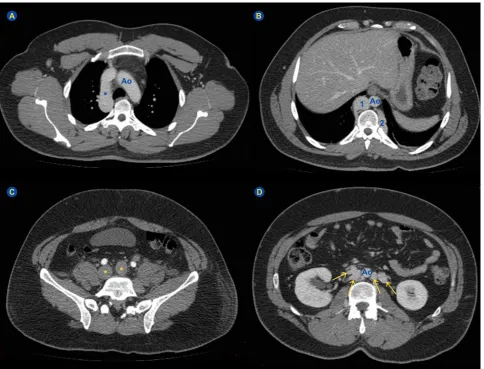 Figure 2 – Axial abdominal computed tomography shows absence of the suprarenal segment of inferior vena cava (arrow)